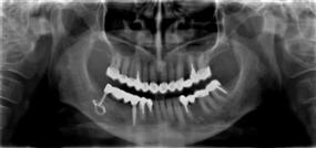 Stav po ošetření pomocí implantátů a keramických můstků