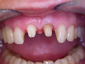 Preparace zubů 11,21 na celokeramické korunky