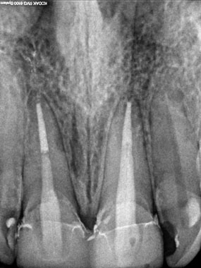 Zuby po endodontickém ošetření a zavedení kompozitních čepů se skelnými vlákny