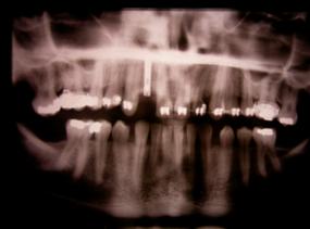 Rentgenový snímek po zavedení implantátu
